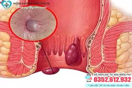 Chữa bệnh trĩ ở đâu