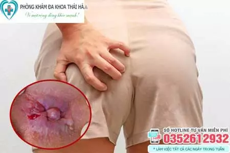 Hình ảnh bệnh trĩ ở nữ giới