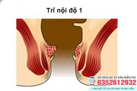 Trĩ nội độ 1 có nguy hiểm không