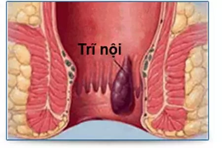 Hình ảnh bệnh trĩ nội