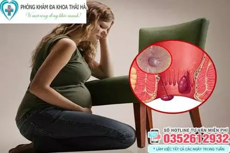 Bà bầu bị bệnh trĩ có sinh thường được không