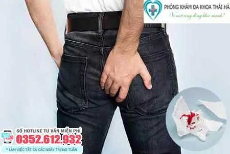 Triệu chứng của bệnh trĩ nội