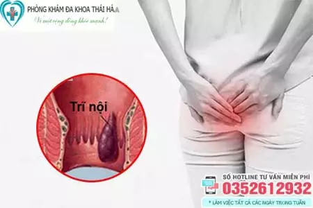 Biểu hiện bệnh trĩ nội