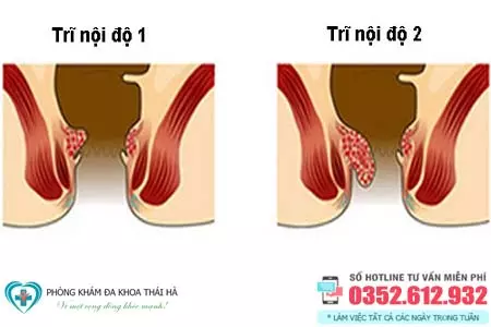 Hình ảnh bệnh trĩ nội độ 1, 2