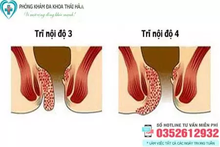 Hình ảnh bệnh trĩ nội độ 3, 4