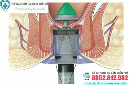 Chi phí chữa bệnh trĩ hết bao nhiêu tiền