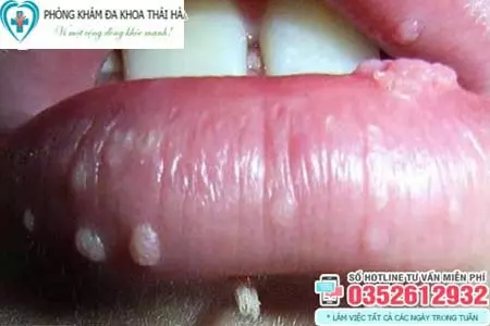 Hình ảnh sùi mào gà ở môi