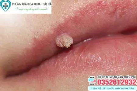 Sùi mào gà ở môi có nguy hiểm không