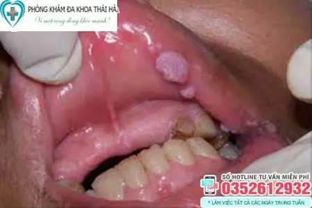Hình ảnh bệnh sùi mào gà ở môi