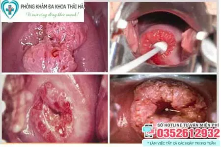 Hình ảnh sùi mào gà ở cổ tử cung nữ giới