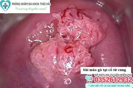 Hình ảnh sùi mào gà mọc ở cổ tử cung nữ giới