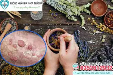 Cách chữa sùi mào gà bằng thuốc nam