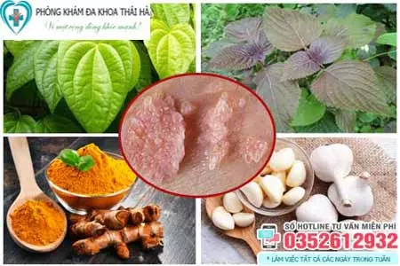 Cách chữa sùi mào gà bằng thuốc nam
