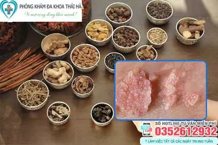 Chữa sùi mào gà bằng Đông y