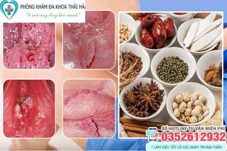 Có nên chữa sùi mào gà bằng thuốc Đông y