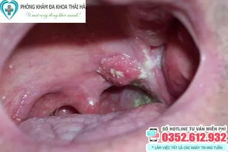 Triệu chứng bệnh sùi mào gà ở miệng