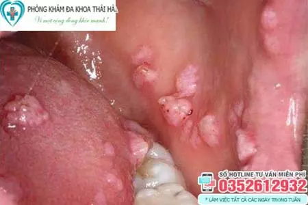 Hình ảnh bệnh sùi mào gà ở miệng giai đoạn đầu