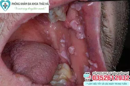 Hình ảnh bệnh sùi mào gà ở miệng
