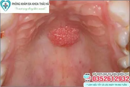 Hình ảnh sùi mào gà ở miệng