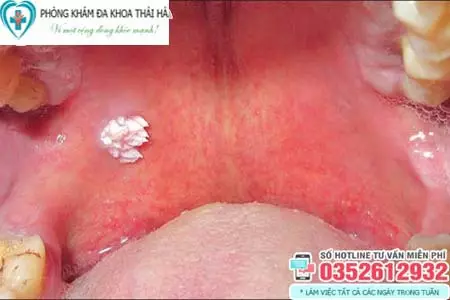 Hình ảnh bị sùi mào gà ở miệng