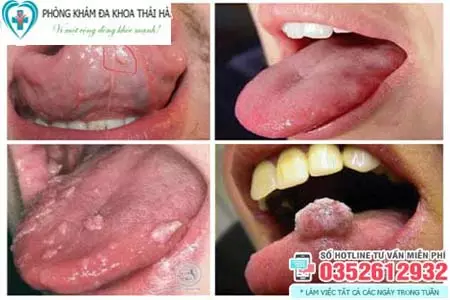 Hình ảnh sùi mào gà ở lưỡi giai đoạn đầu