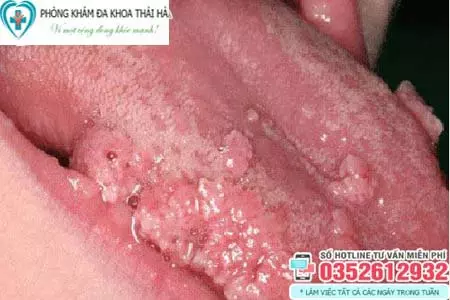 Hình ảnh sùi mào gà ở lưỡi