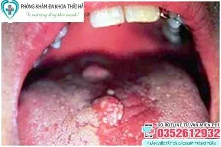 Hình ảnh bệnh sùi mào gà ở lưỡi