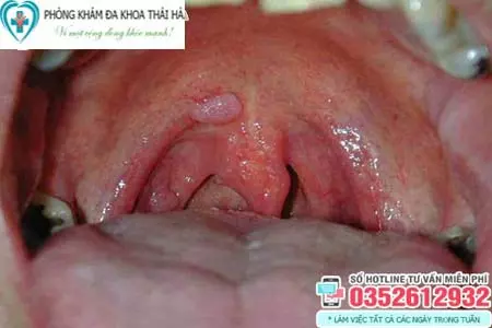 Hình ảnh sùi mào gà ở họng