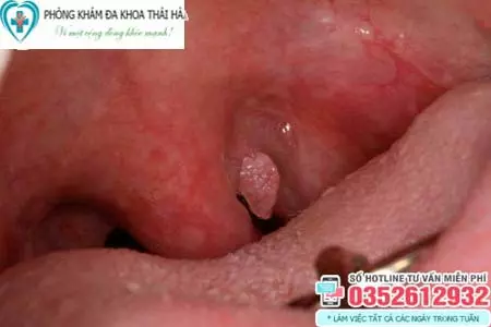 Hình ảnh sùi mào gà ở vòm họng