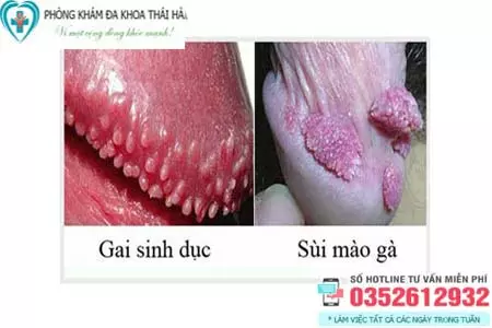 Gai sinh dục và sùi mào gà khác nhau như thế nào