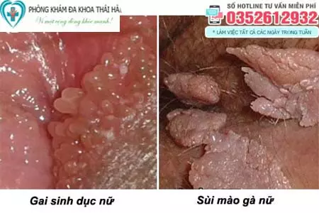 Hình ảnh gai sinh dục và sùi mào gà ở nữ