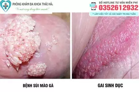Gai sinh dục khác với sùi mào gà như thế nào
