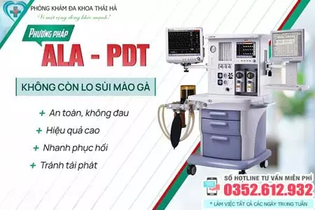 Chữa sùi mào gà bằng phương pháp ALA-PDT