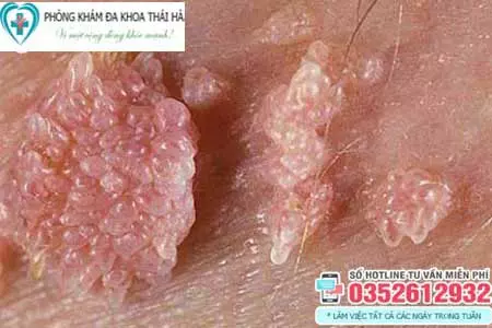 Sùi mào gà có gây ngứa không