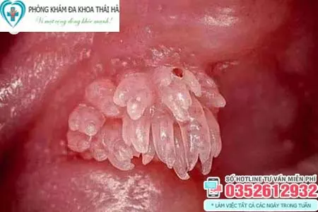 Dấu hiệu bệnh sùi mào gà ở nam giới