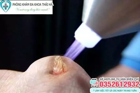 Đốt sùi mào gà có quan hệ được không