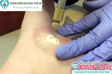 Đốt sùi mào gà bao nhiêu tiền