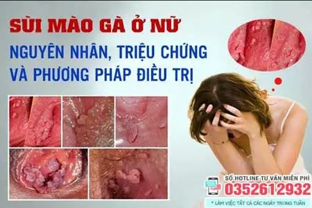 Sùi mào gà ở nữ giới