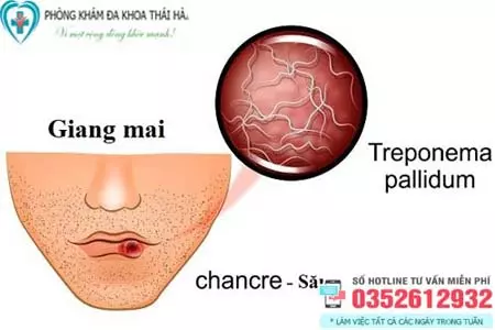 Bệnh giang mai ở miệng