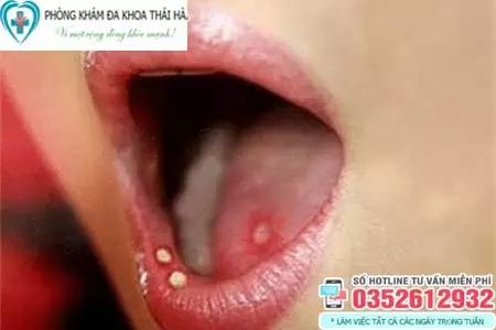 Hình ảnh bệnh giang mai ở miệng, lưỡi