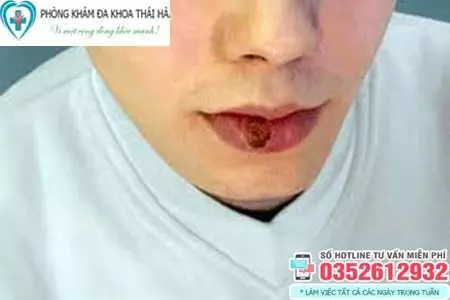 Bệnh giang mai ở môi