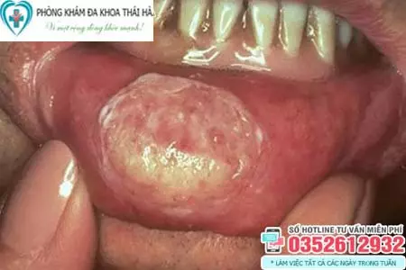 Hình ảnh bệnh giang mai ở môi