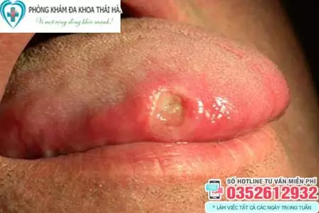 Hình ảnh bệnh giang mai ở lưỡi
