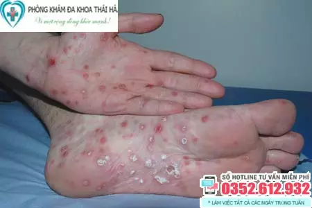 Giang mai ủ bệnh bao lâu