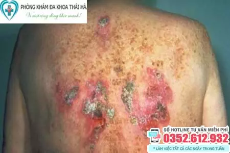 Bệnh giang mai ở nam giới