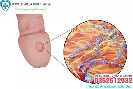 Triệu chứng bệnh giang mai ở nam giới