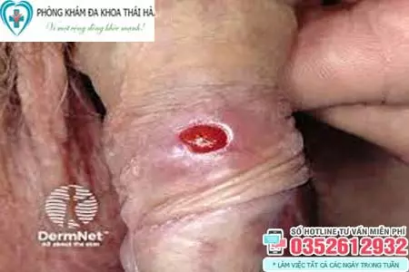 Hình ảnh bệnh giang mai ở vùng kín nam giới