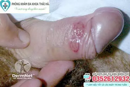 Hình ảnh bệnh giang mai ở bộ phận sinh dục nam