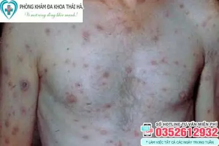 Hình ảnh giang mai ở nam