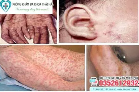 Bệnh giang mai có chữa được không